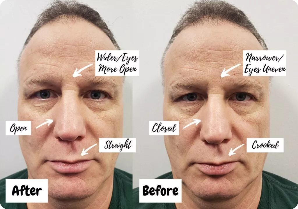 Endonasal Correction